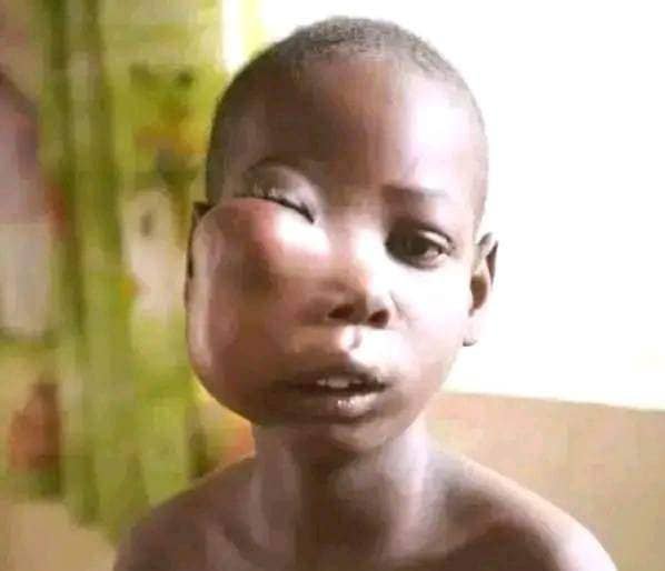 12-year-old battles facial tumour, family seeks help